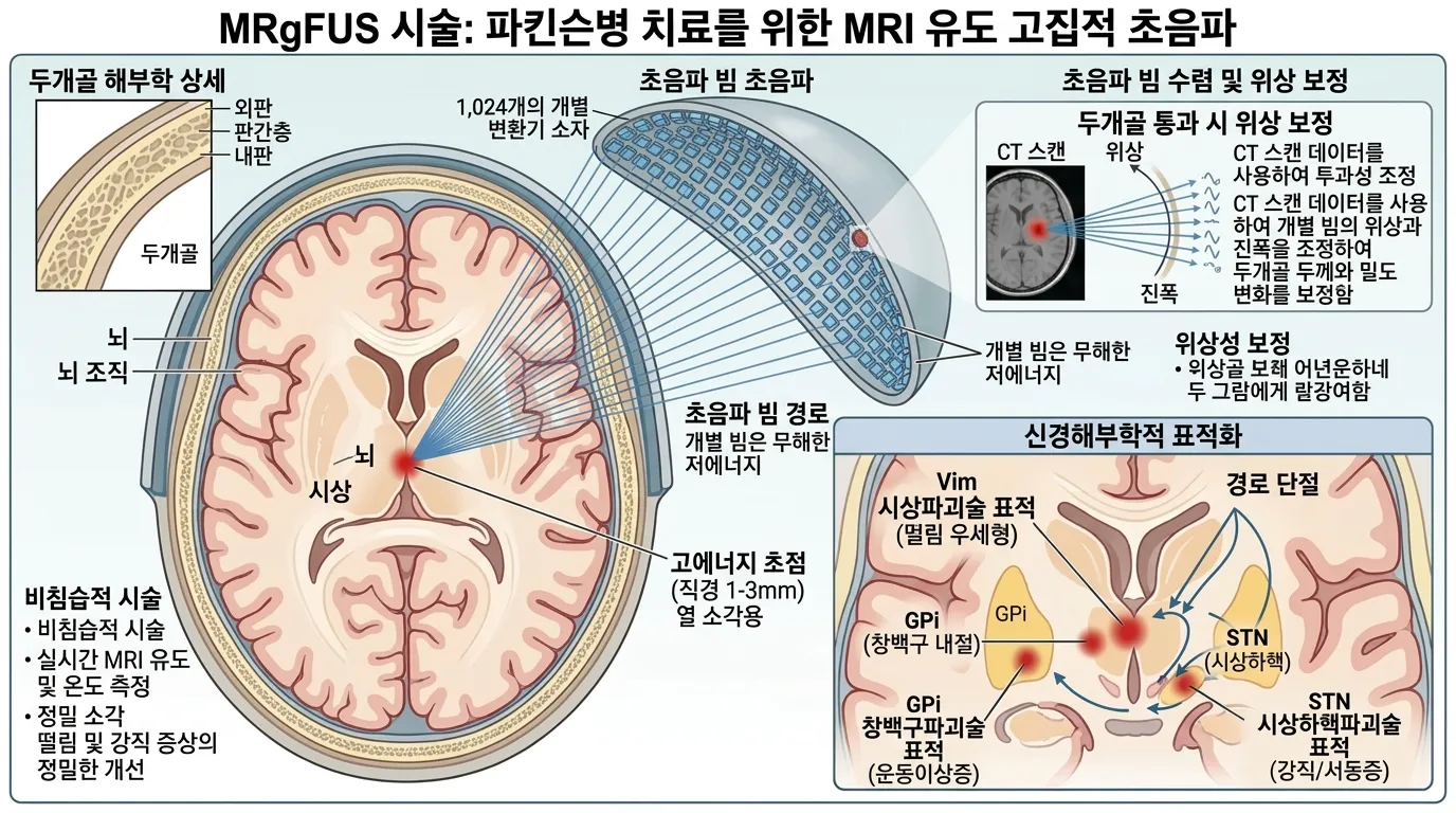 MRgFUS 원리 — 물리학적 기전과 신경해부학적 표적